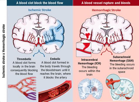 stroke tradução|STROKE .